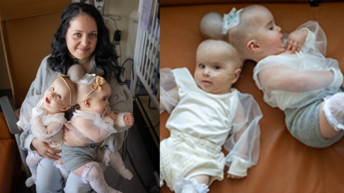 9-Month-Old Inseparable Twins Are Already Separated