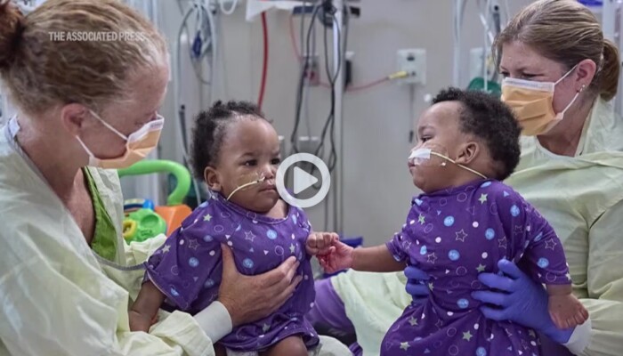 Twin boys born conjoined celebrate 1st birthday after separation surgery